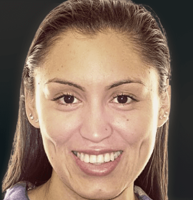 Adults patient 1 smile after orthodontic treatment