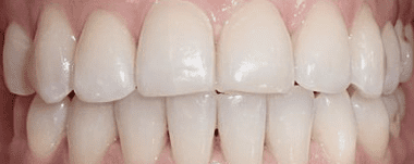 Adults patient 1 teeth after orthodontic treatment