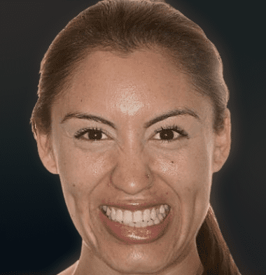 Adults patient 1 smile before orthodontic treatment