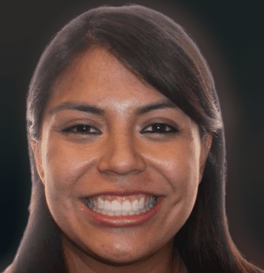 Adults patient 2 smile after orthodontic treatment