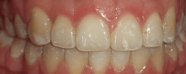Adults patient 2 teeth after orthodontic treatment
