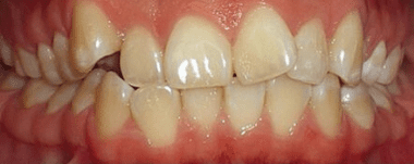 Adults patient 2 teeth before orthodontic treatment