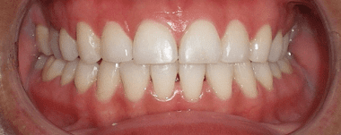 Adults patient 4 teeth after orthodontic treatment