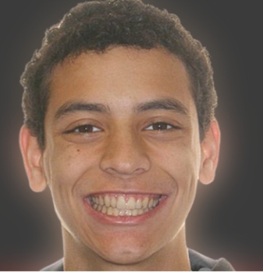 Kids patient 1 smile after orthodontic treatment
