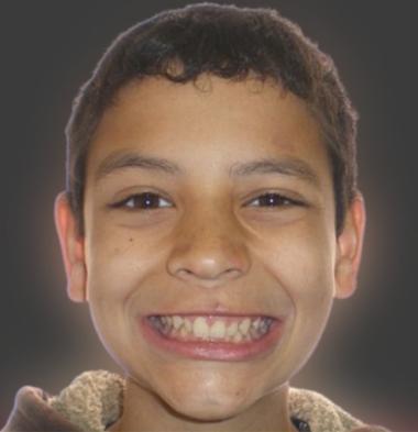 Kids patient 1 smile before orthodontic treatment