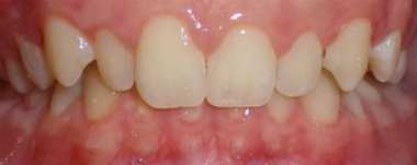 Kids patient 1 teeth before orthodontic treatment