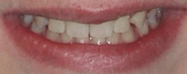 Kids patient 2 teeth after orthodontic treatment