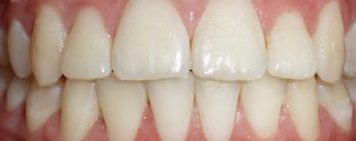 Kids patient 3 teeth after orthodontic treatment
