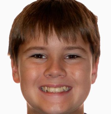 Kids patient 3 smile before orthodontic treatment