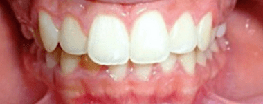 Kids patient 4 teeth after orthodontic treatment