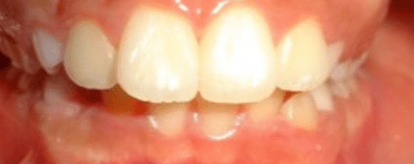 Kids patient 4 teeth before orthodontic treatment