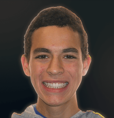Kids patient 5 smile after orthodontic treatment