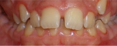 Teens patient 1 teeth after orthodontic treatment